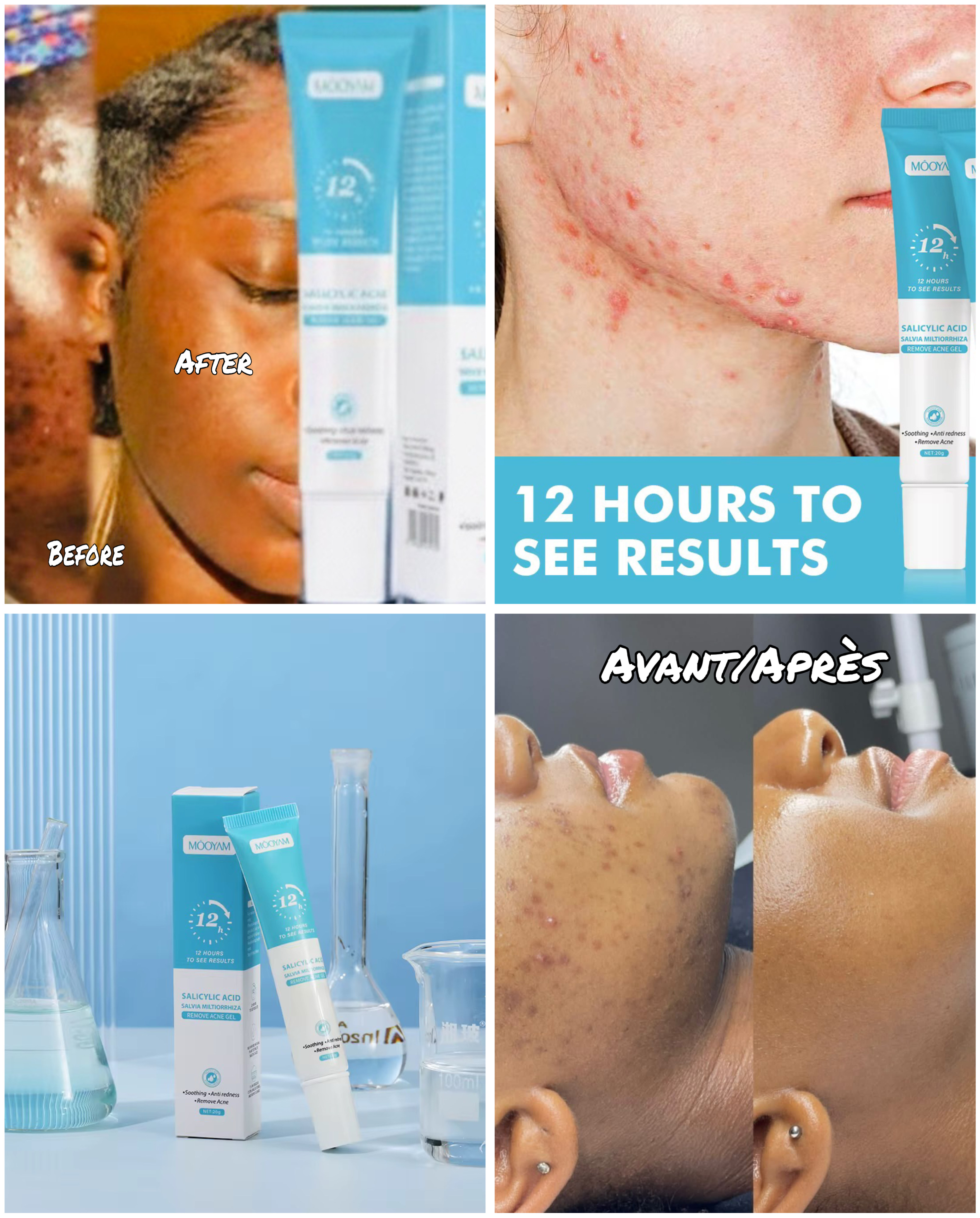 Mooyam anti acné, anti boutons noirs rapide et efficace